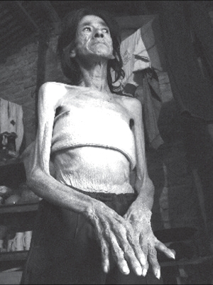 Rosa Molina, de la provinicia de Chaco, otra vctima de la desnutricin